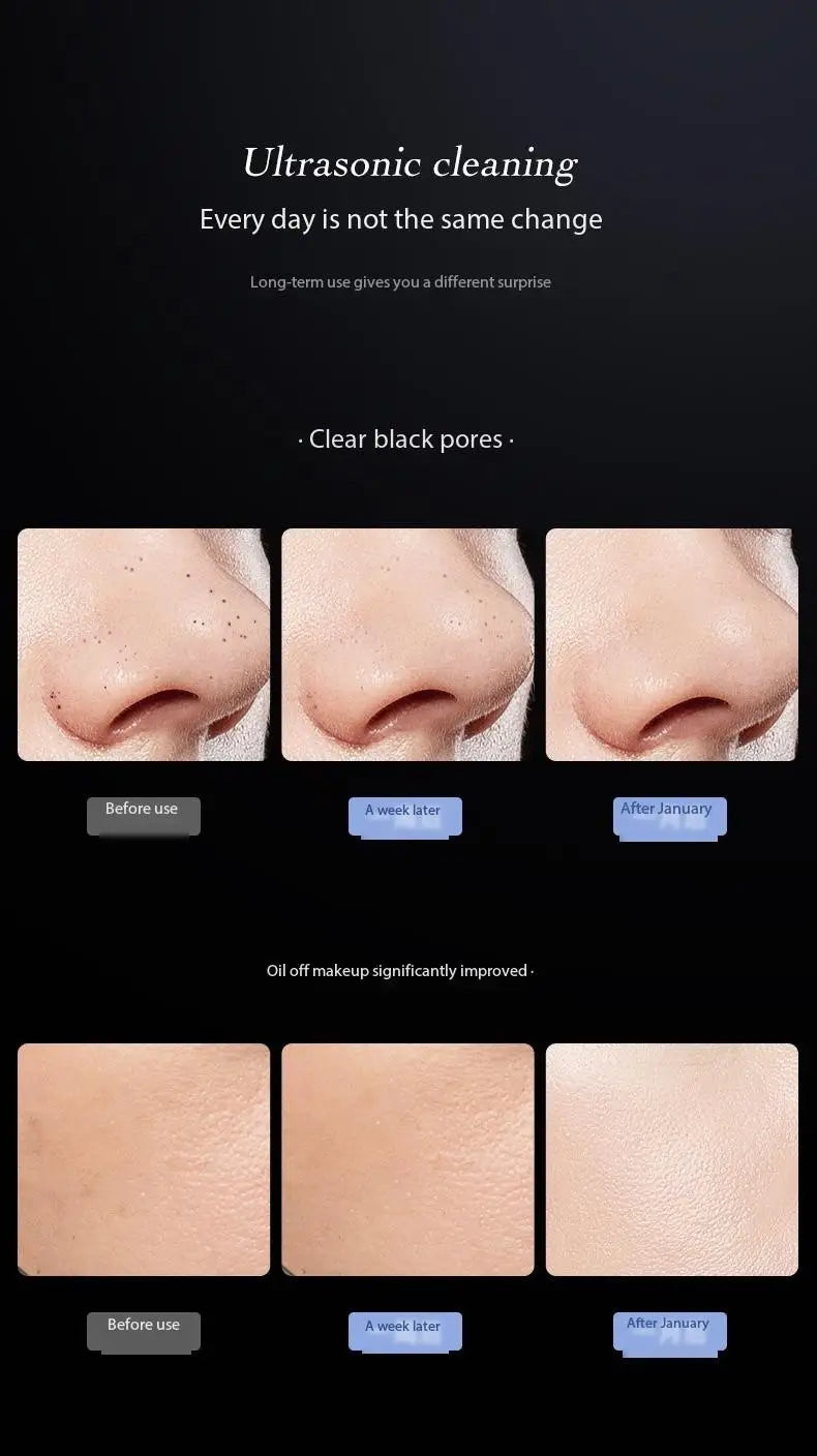 Blackhead Remover | Blackhead Cleaning Pore Shrinking Beauty Device